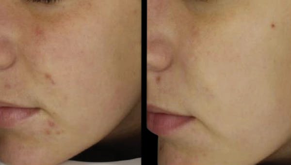 Toskani (Peptides) Before & After Gallery - Patient 318004 - Image 1
