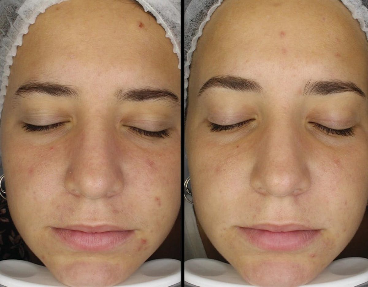 Toskani (Peptides) Before & After Gallery - Patient 318004 - Image 2