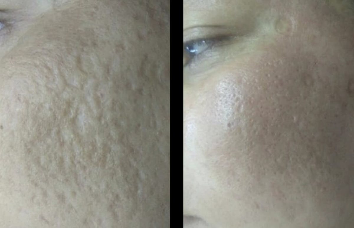 Toskani (Peptides) Before & After Gallery - Patient 438256 - Image 1