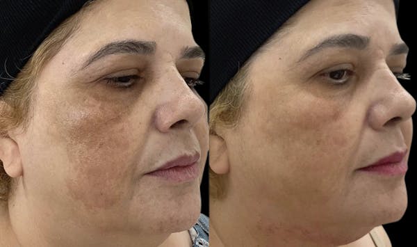 Toskani (Peptides) Before & After Gallery - Patient 885258 - Image 1