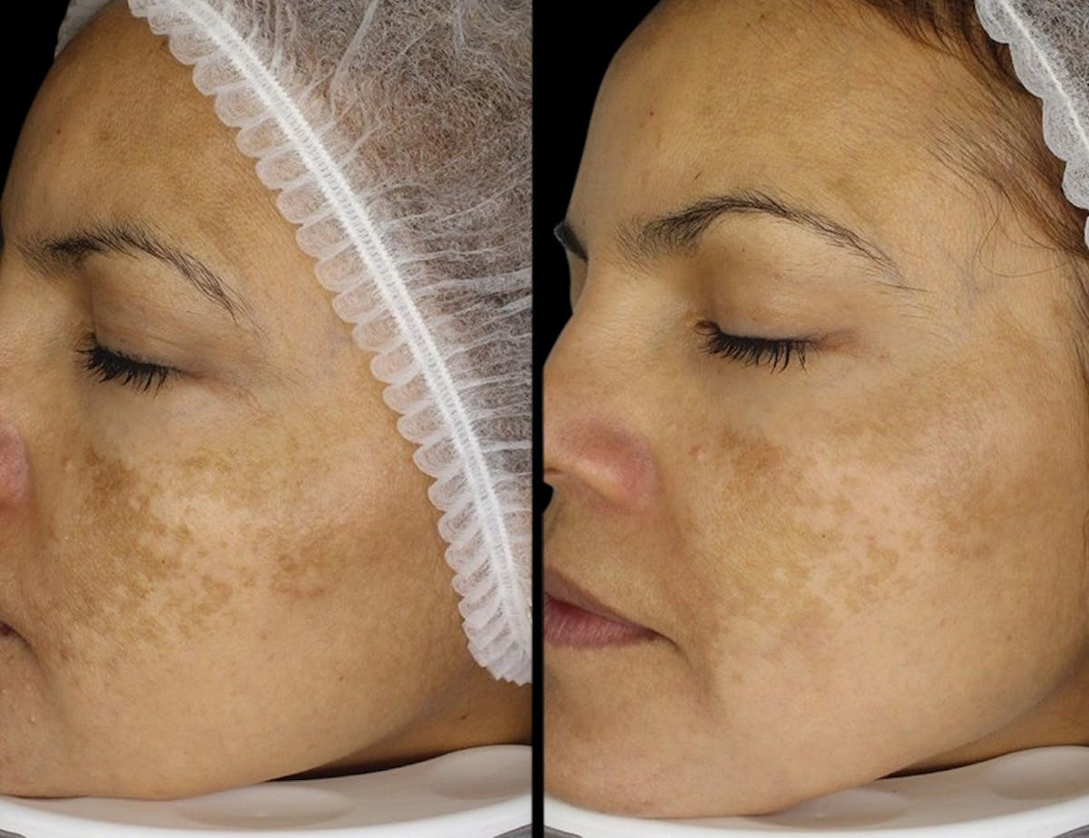 Toskani (Peptides) Before & After Gallery - Patient 264182 - Image 1