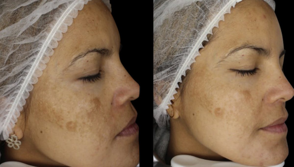 Toskani (Peptides) Before & After Gallery - Patient 264182 - Image 2