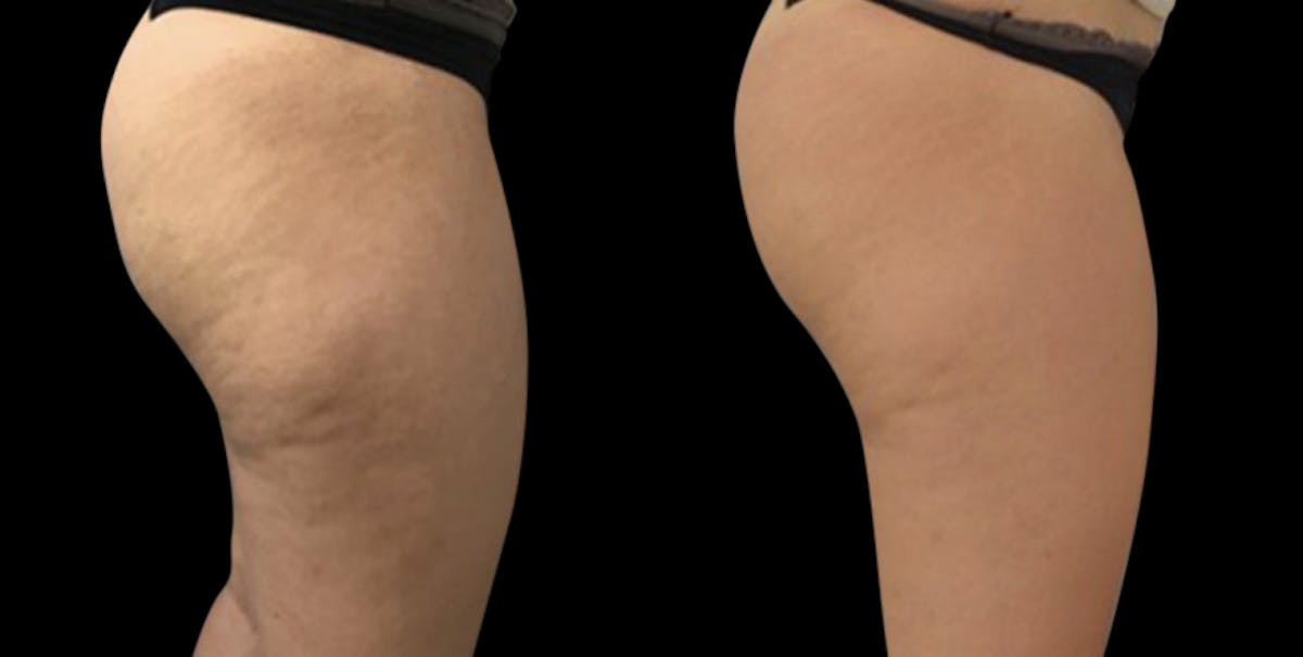 Toskani (Peptides) Before & After Gallery - Patient 223767 - Image 1