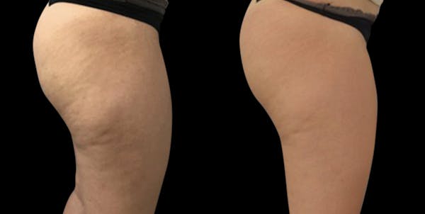 Toskani (Peptides) Before & After Gallery - Patient 223767 - Image 1