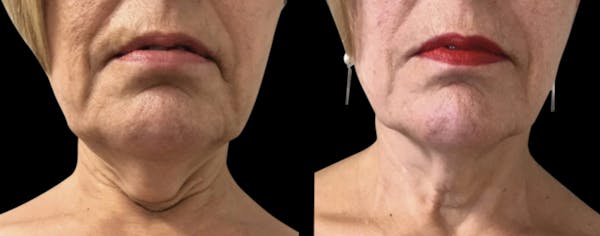 Toskani (Peptides) Before & After Gallery - Patient 198370 - Image 1