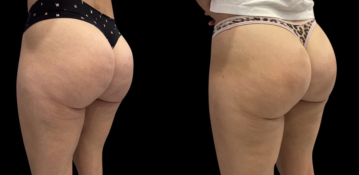 Avéli® Before & After Gallery - Patient 163481 - Image 2
