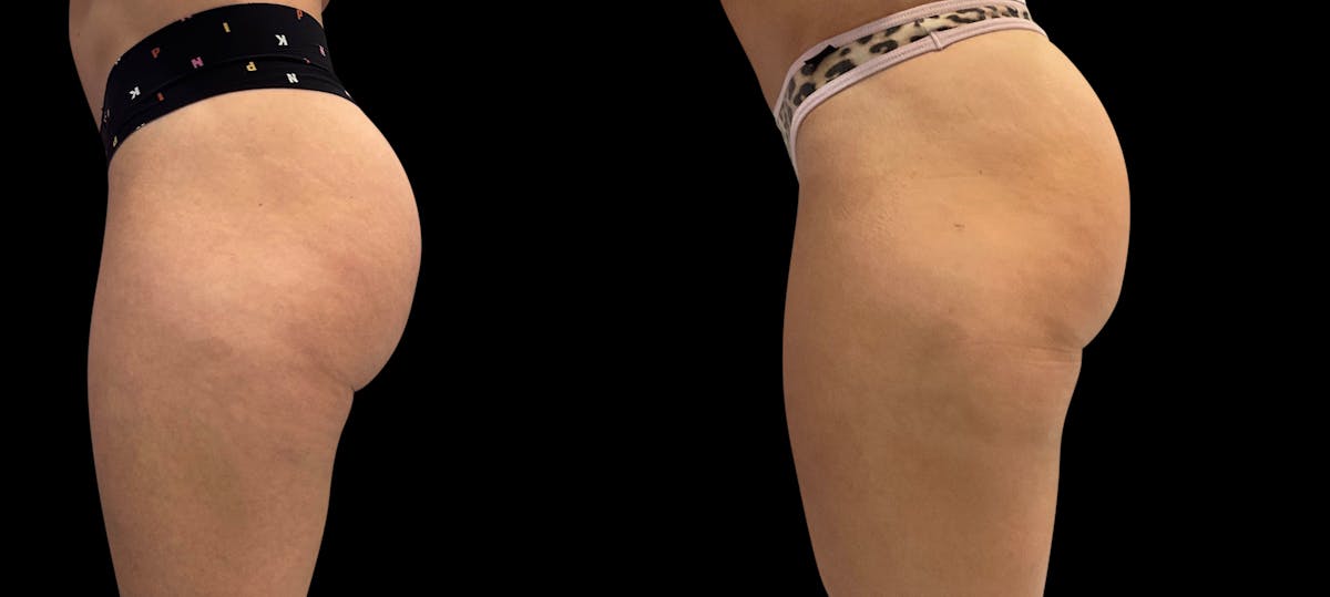 Avéli® Before & After Gallery - Patient 163481 - Image 3