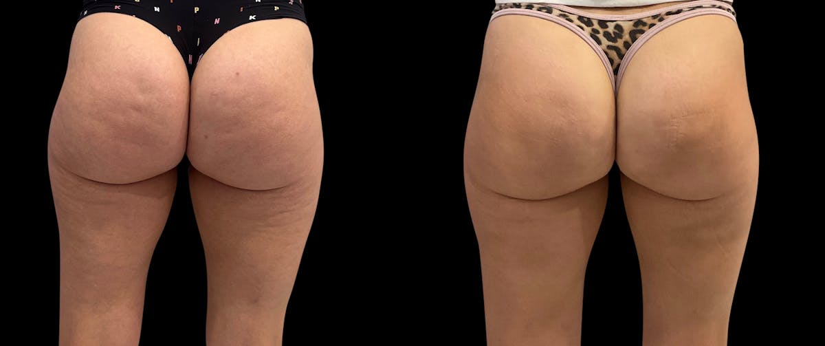 Avéli® Before & After Gallery - Patient 163481 - Image 1