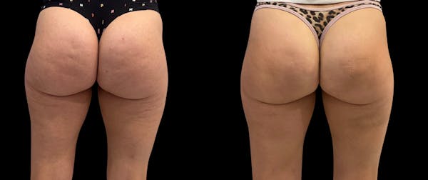 Avéli® Before & After Gallery - Patient 163481 - Image 1