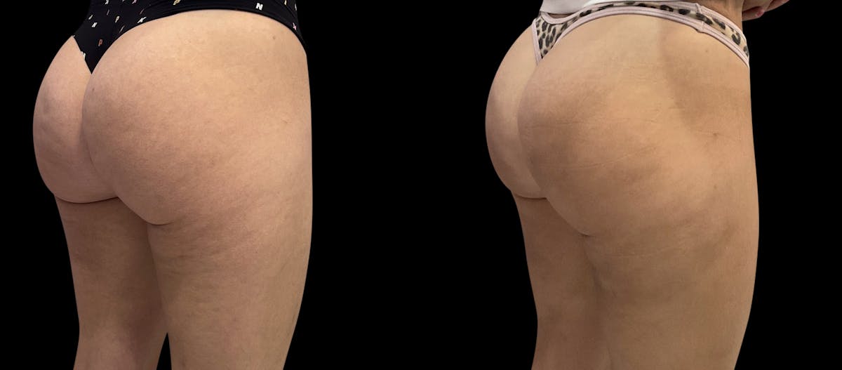 Avéli® Before & After Gallery - Patient 163481 - Image 4