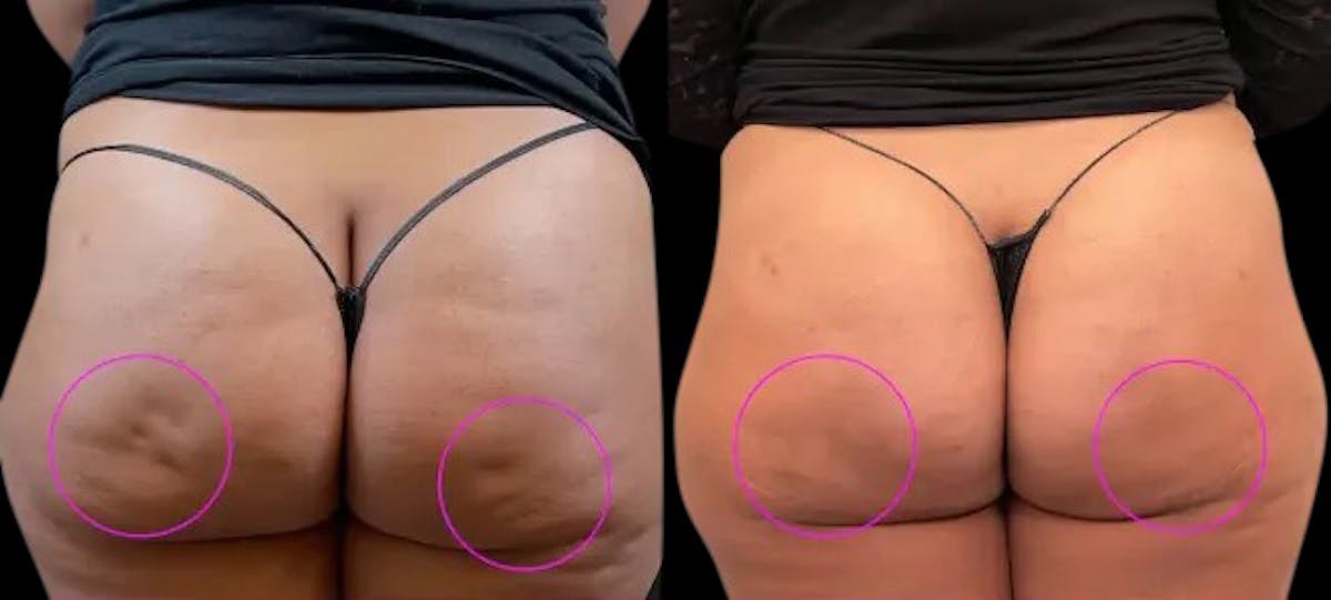 Avéli® Before & After Gallery - Patient 116486 - Image 1