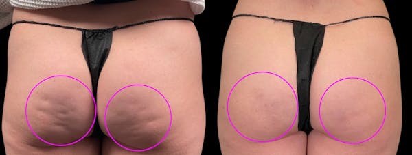 Avéli® Before & After Gallery - Patient 336895 - Image 1