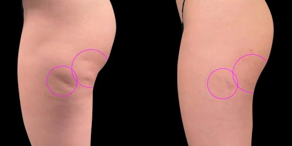 Avéli® Before & After Gallery - Patient 424062 - Image 1
