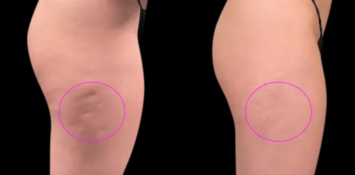 Avéli® Before & After Gallery - Patient 424062 - Image 2