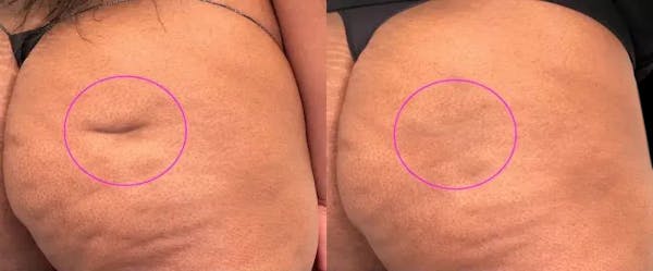 Avéli® Before & After Gallery - Patient 116801 - Image 1
