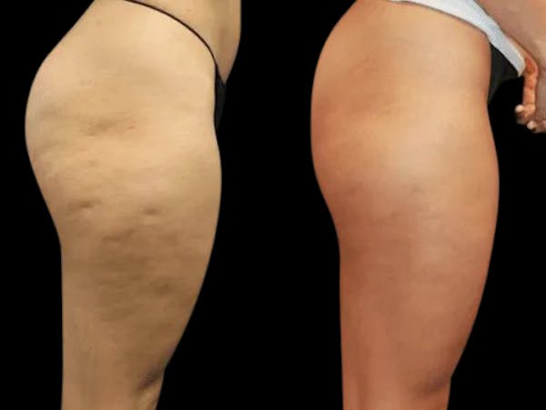 Avéli® Before & After Gallery - Patient 208267 - Image 1