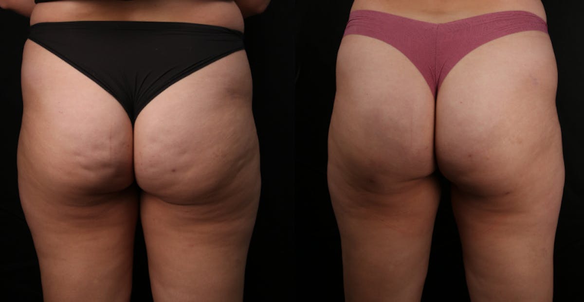 Avéli® Before & After Gallery - Patient 388087 - Image 1