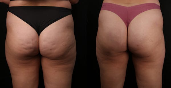 Avéli® Before & After Gallery - Patient 388087 - Image 1