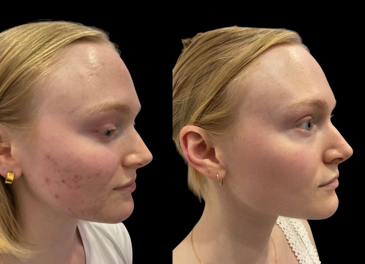 Aviclear Before & After Gallery - Patient 139406 - Image 2
