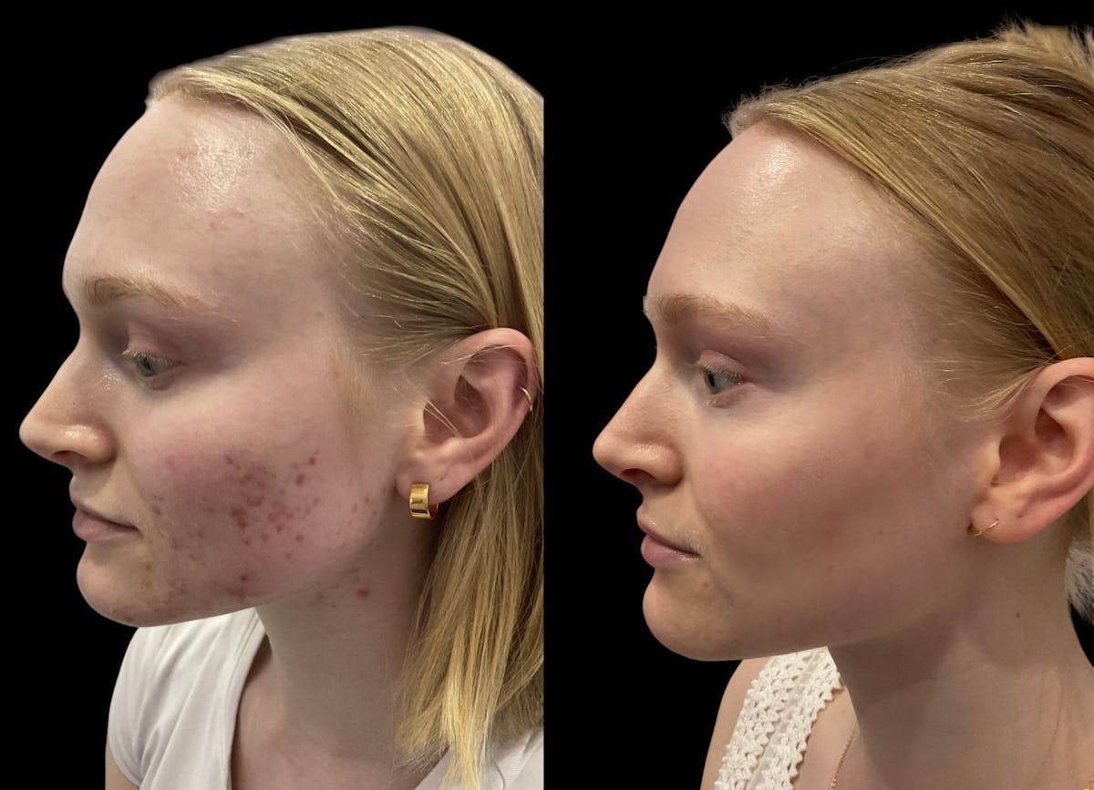 Aviclear Before & After Gallery - Patient 139406 - Image 3