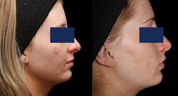 Aviclear Before & After Gallery - Patient 159684 - Image 1
