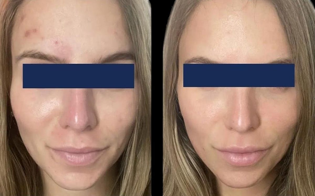 Aviclear Before & After Gallery - Patient 104095 - Image 1