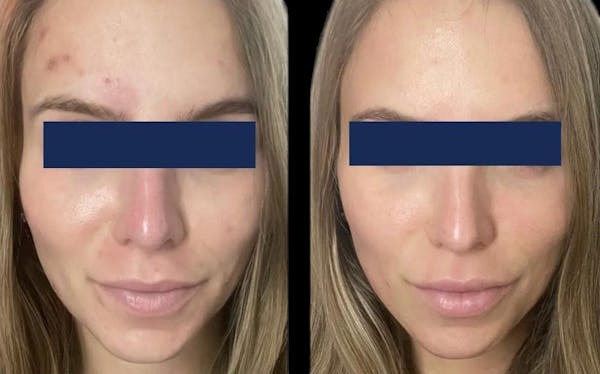 Aviclear Before & After Gallery - Patient 104095 - Image 1