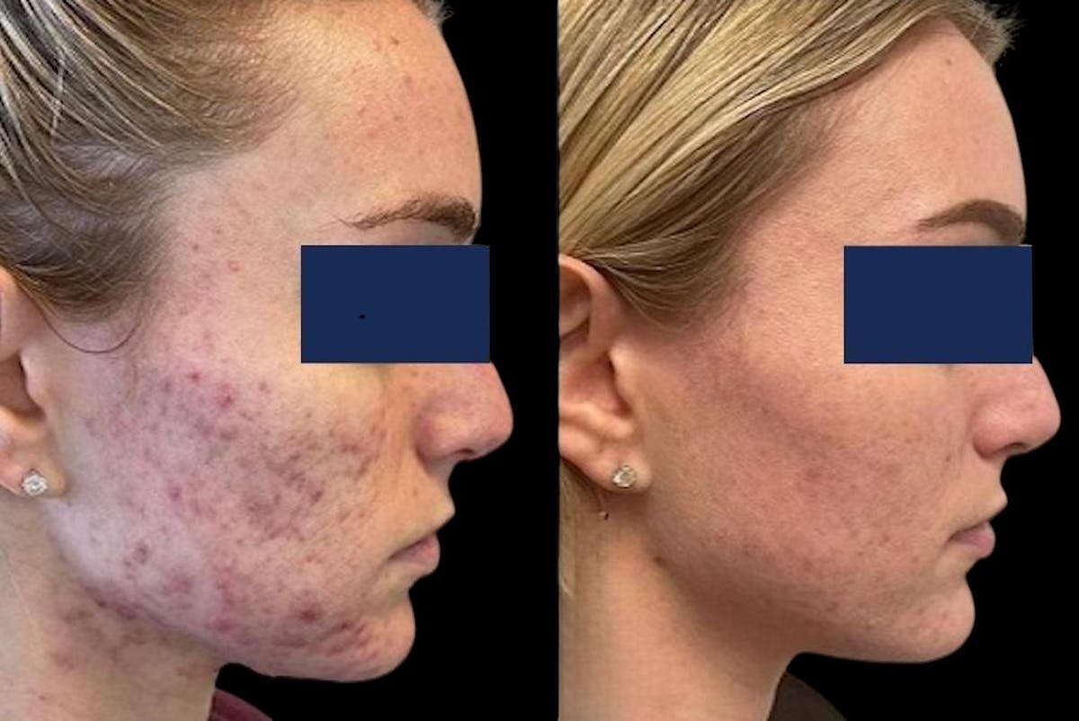 Aviclear Before & After Gallery - Patient 232868 - Image 1