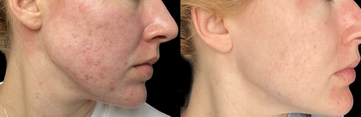 Aviclear Before & After Gallery - Patient 158652 - Image 1