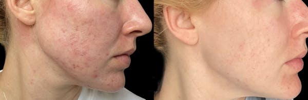 Aviclear Before & After Gallery - Patient 158652 - Image 1