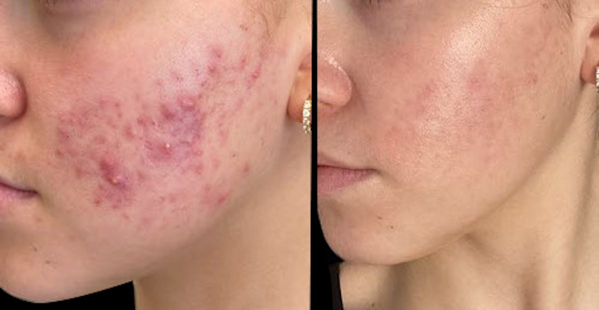 Aviclear Before & After Gallery - Patient 289482 - Image 1