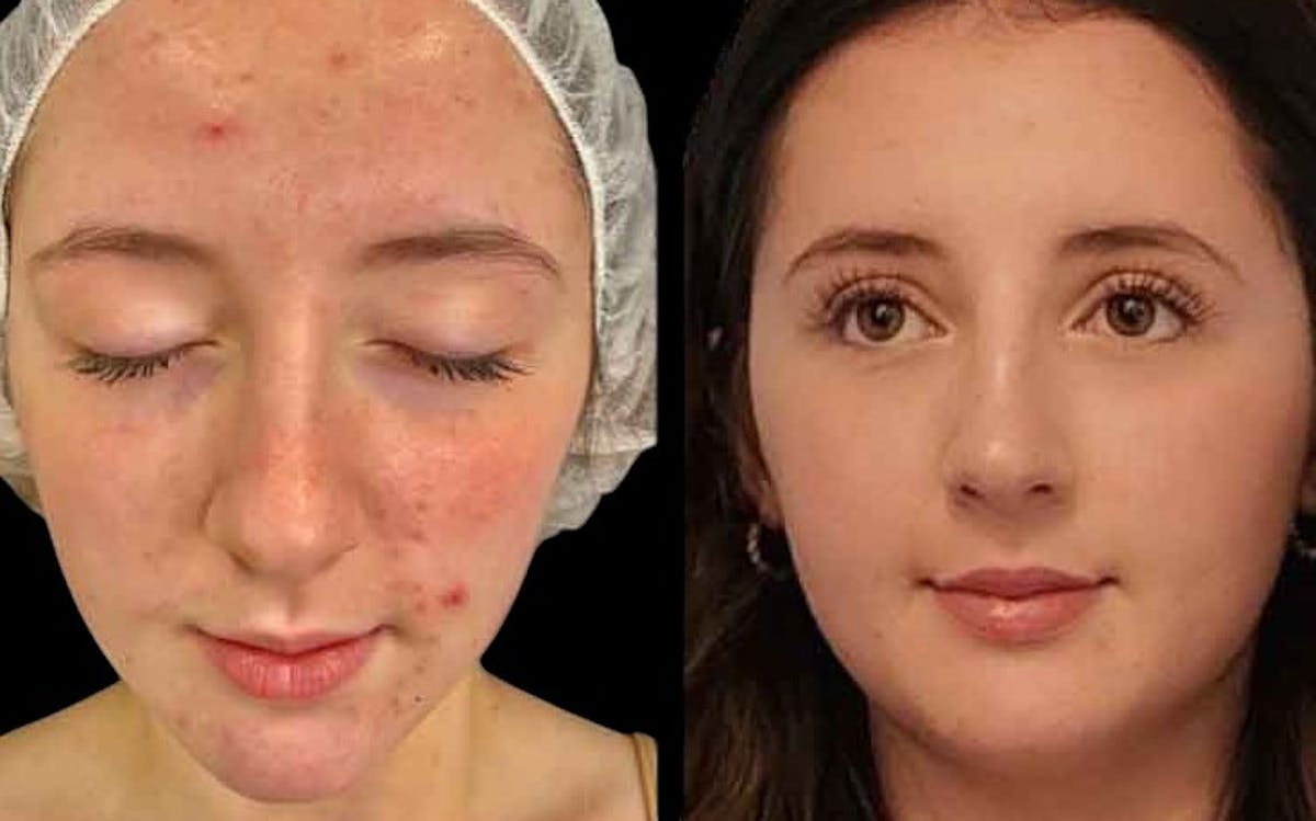 Aviclear Before & After Gallery - Patient 148544 - Image 1