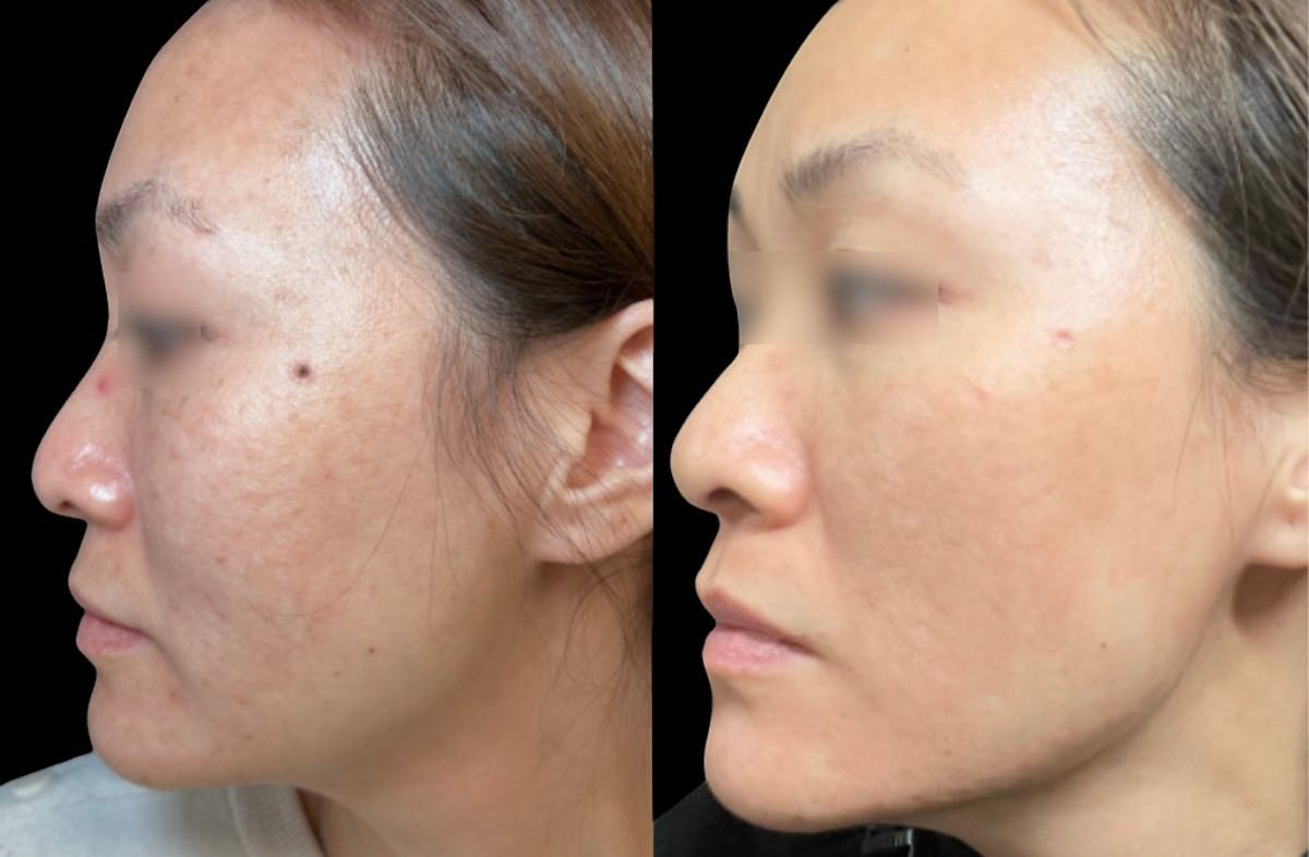 Aviclear Before & After Gallery - Patient 240013 - Image 1