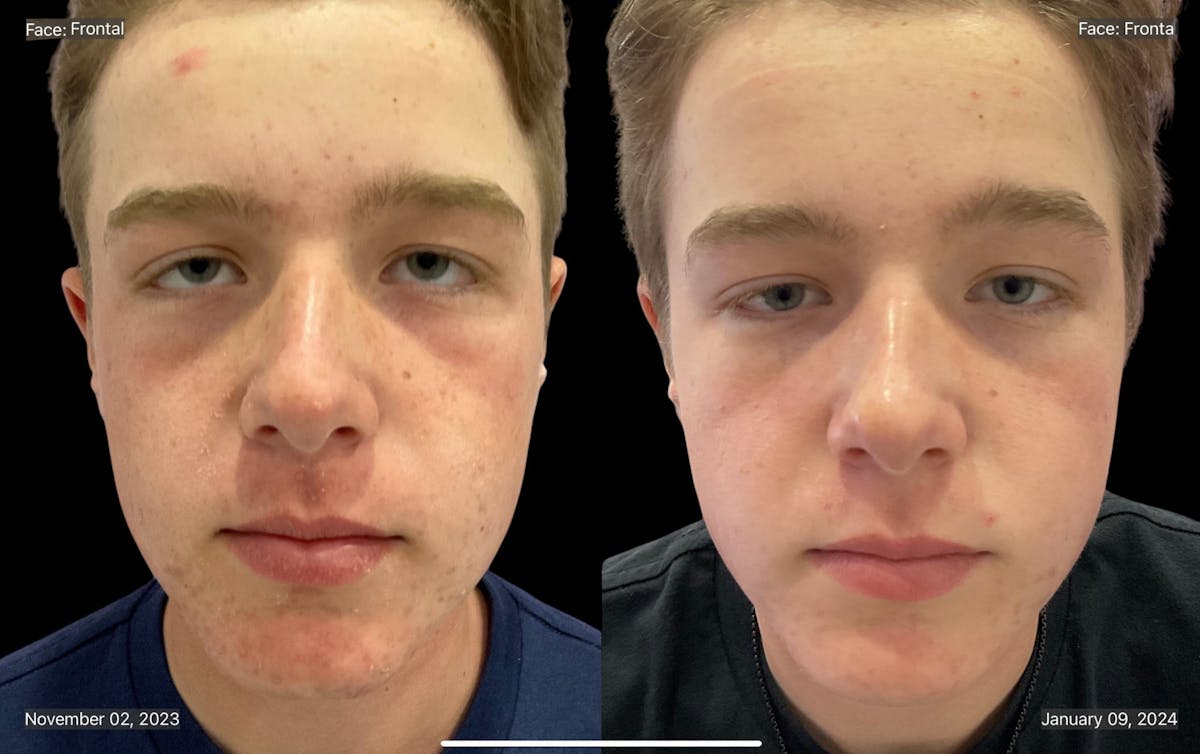 Aviclear Before & After Gallery - Patient 132729 - Image 1