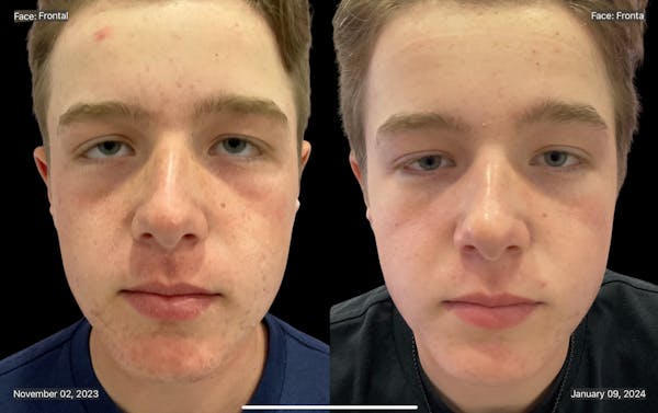 Aviclear Before & After Gallery - Patient 132729 - Image 1
