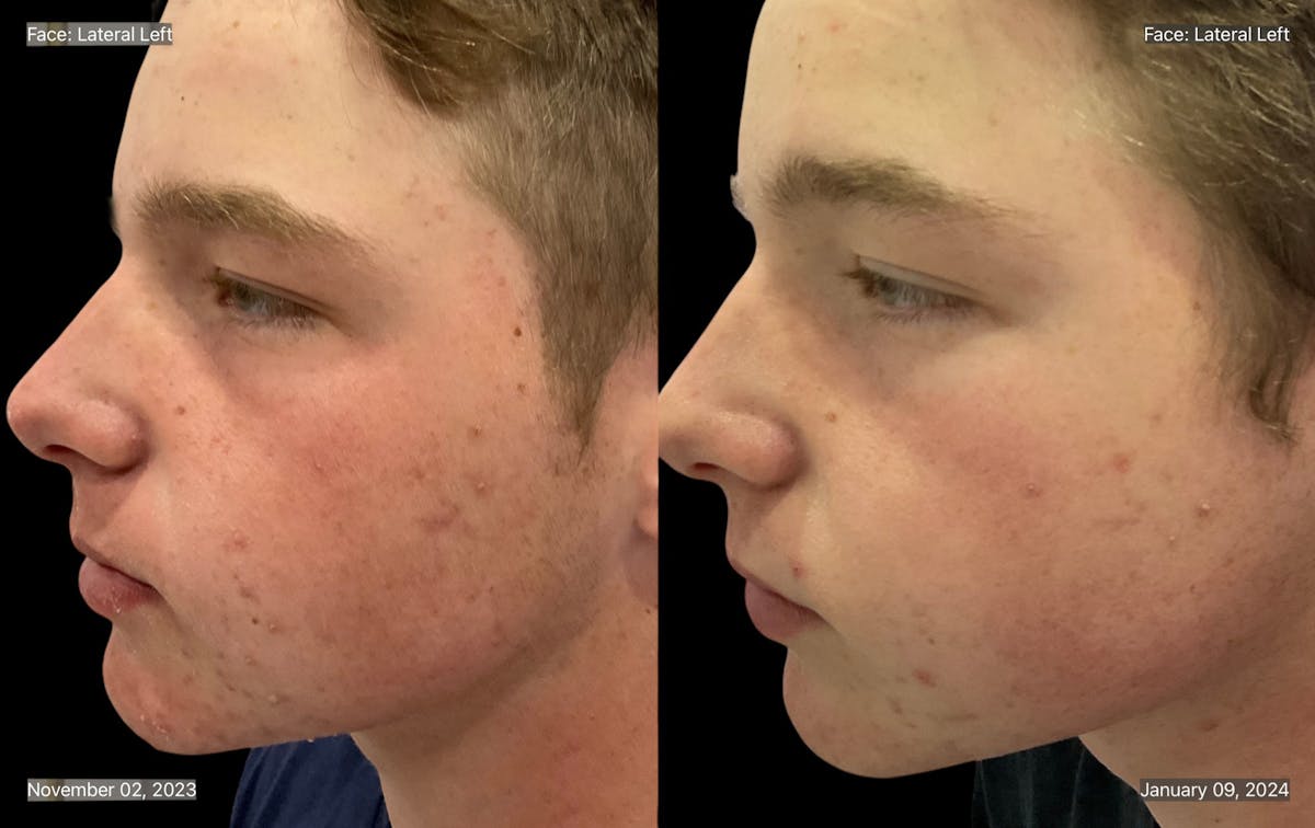 Aviclear Before & After Gallery - Patient 132729 - Image 2
