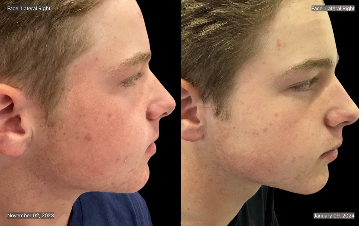 Aviclear Before & After Gallery - Patient 132729 - Image 3