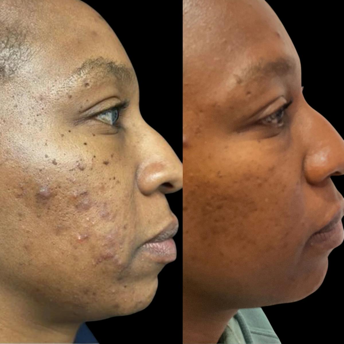 Aviclear Before & After Gallery - Patient 875053 - Image 1