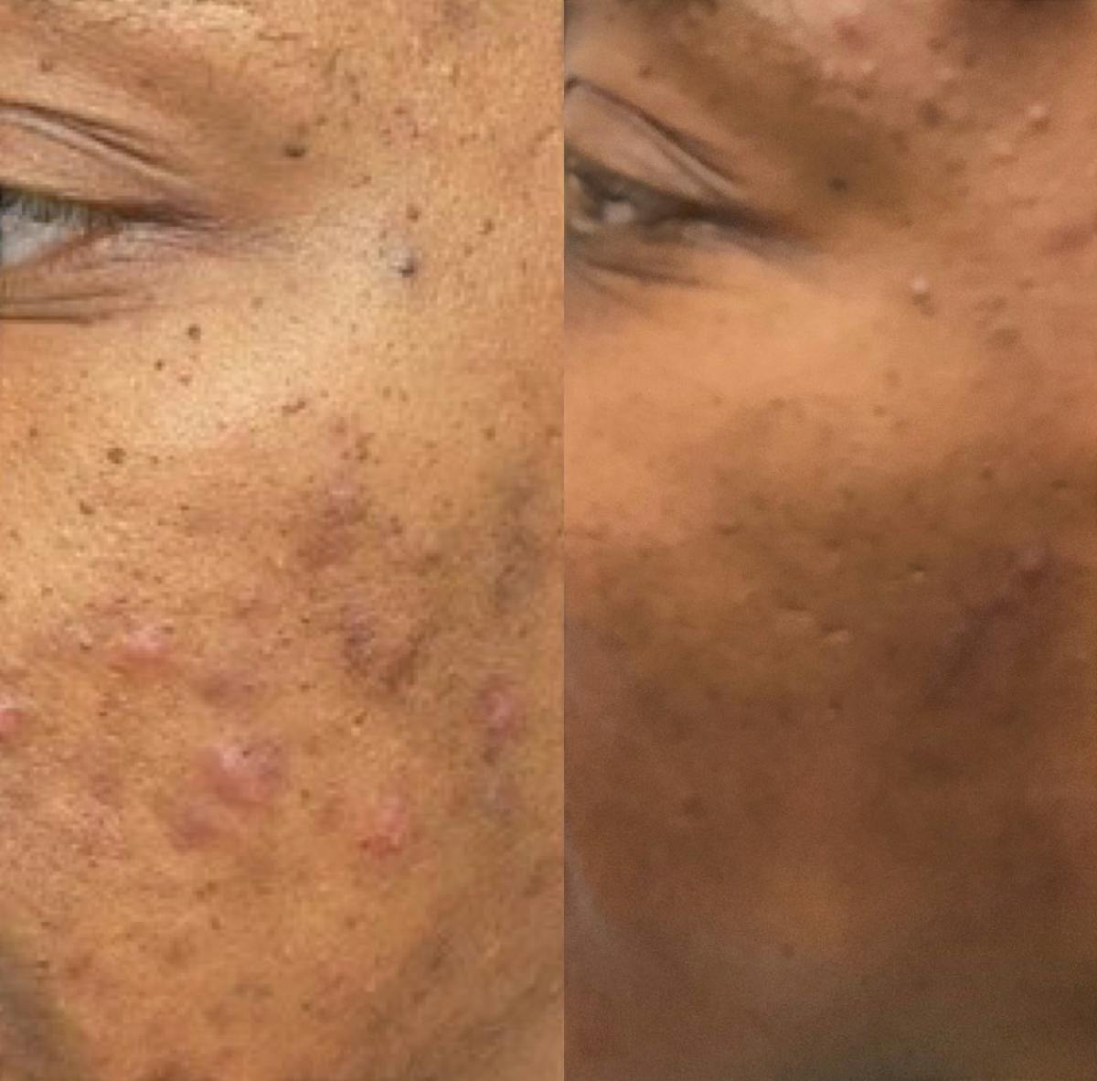 Aviclear Before & After Gallery - Patient 875053 - Image 2
