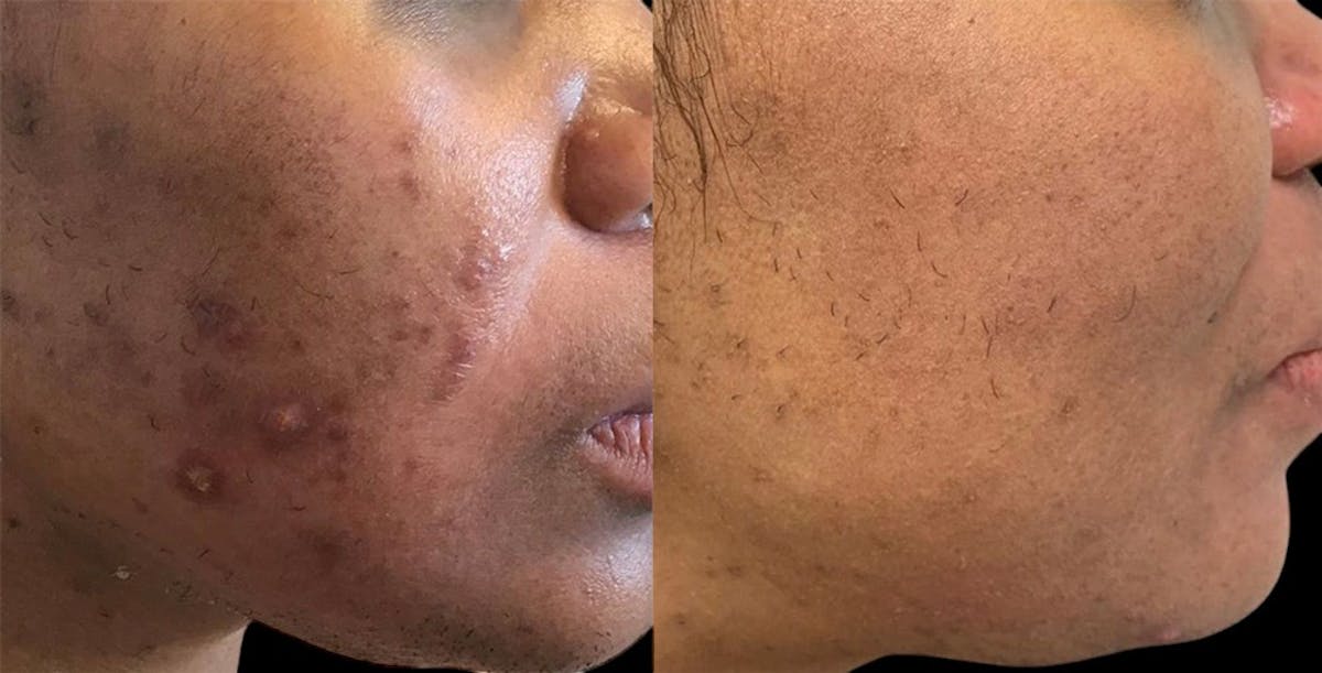 Aviclear Before & After Gallery - Patient 229750 - Image 1