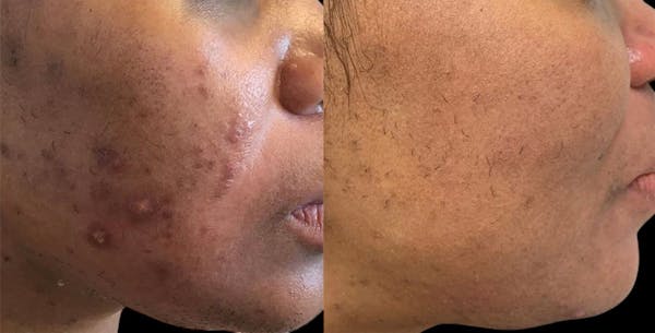 Aviclear Before & After Gallery - Patient 229750 - Image 1