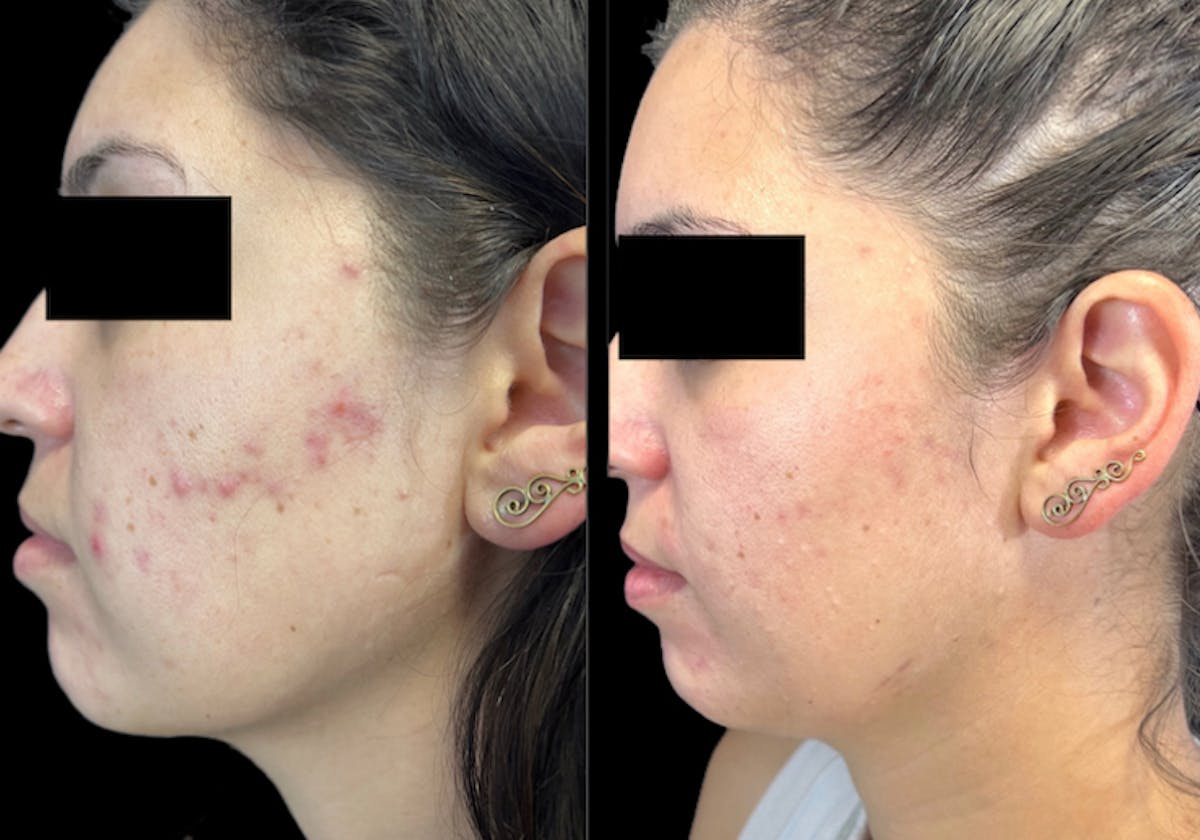 Aviclear Before & After Gallery - Patient 225609 - Image 1