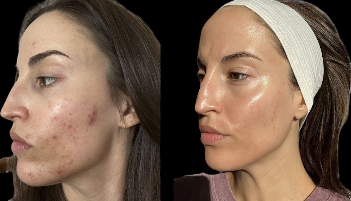 Aviclear Before & After Gallery - Patient 176135 - Image 1