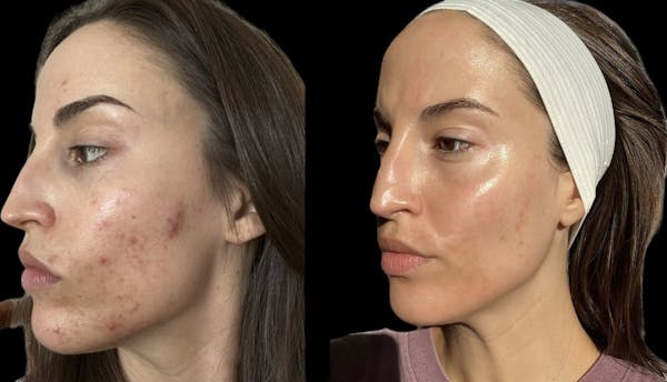 Aviclear Before & After Gallery - Patient 176135 - Image 1