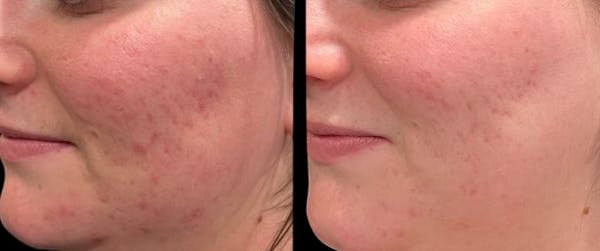 Aviclear Before & After Gallery - Patient 331806 - Image 1