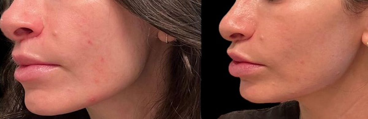 Aviclear Before & After Gallery - Patient 279794 - Image 1