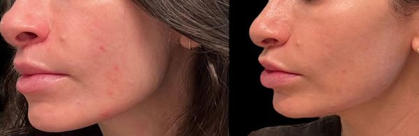 Aviclear Before & After Gallery - Patient 279794 - Image 1