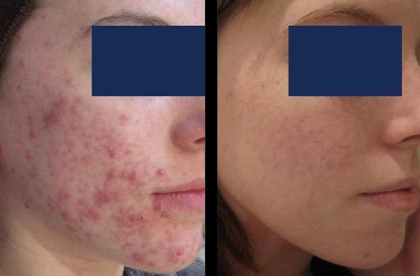 Aviclear Before & After Gallery - Patient 229045 - Image 1