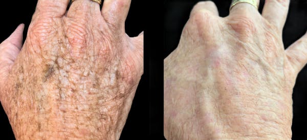 IPL Before & After Gallery - Patient 946506 - Image 1
