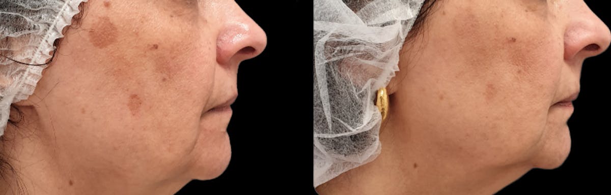 IPL Before & After Gallery - Patient 241753 - Image 1